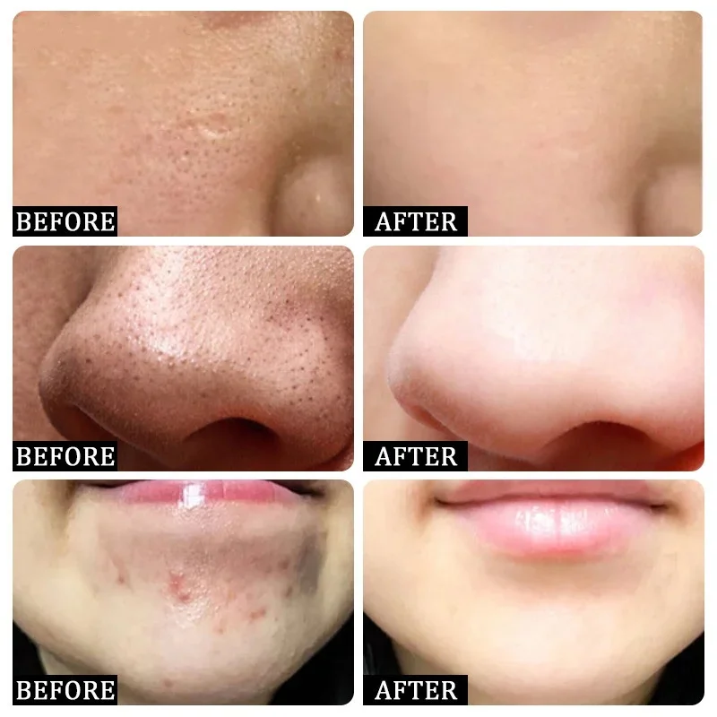 Крем для очищения пор с салици – обзор и цена Salicylic Acid Blackhead Remover